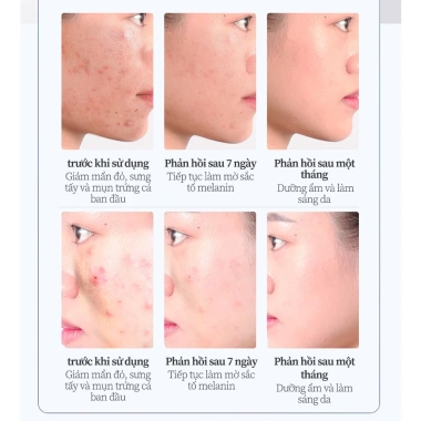 Mua 2 tặng 1 Kem chấm mụn cấp tốc 25g, loại bỏ mụn đầu đen, mụn tuổi dậy thì, da dầu, giá chỉ 60.000