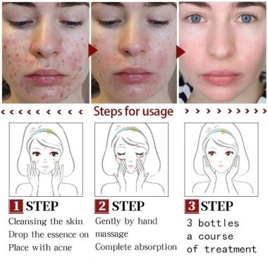 Mua 2 tặng 1 Kem chấm mụn cấp tốc 25g, loại bỏ mụn đầu đen, mụn tuổi dậy thì, da dầu, giá chỉ 60.000 7 Mua 2 tặng 1 Kem chấm mụn cấp tốc 25g, loại bỏ mụn đầu đen, mụn tuổi dậy thì, da dầu, giá chỉ 60.000 7