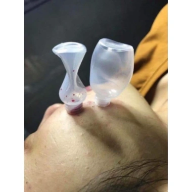 Ống hút mụn máu bầm spa 100 ống dày hút mạnh - Giá chỉ 79.000 VNĐ 2