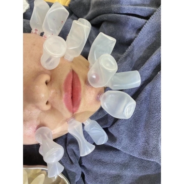 Ống hút mụn máu bầm spa 100 ống dày hút mạnh - Giá chỉ 79.000 VNĐ 4
