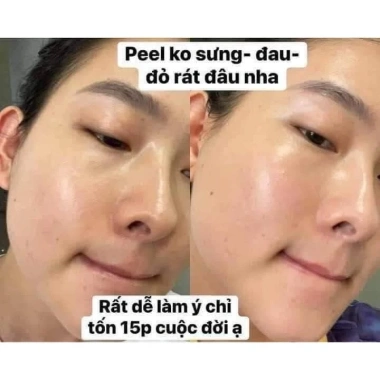 Peel Da Sinh Học SKY BIO - Dưỡng ẩm, Ngăn bong tróc da mặt và tay, 890.000 VND 9 Peel Da Sinh Học SKY BIO - Dưỡng ẩm, Ngăn bong tróc da mặt và tay, 890.000 VND 9