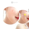 QrhYK 51 miếng dán mụn da mặt, phai màu vết mụn, đóng mụn nhanh, giảm 20% 4