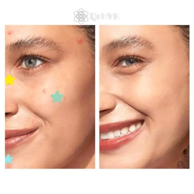 QrhYK 51 miếng dán mụn da mặt, phai màu vết mụn, đóng mụn nhanh, giảm 20% 6