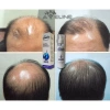 Serum Aveline Mỹ - Kích mọc tóc mạnh, nhanh, dày chắc, chính hãng 1.8tr 4