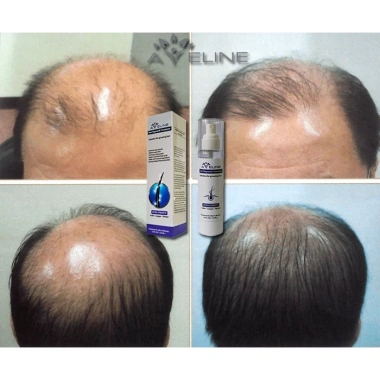 Serum Aveline Mỹ - Kích mọc tóc mạnh, nhanh, dày chắc, chính hãng 1.8tr 4 Serum Aveline Mỹ - Kích mọc tóc mạnh, nhanh, dày chắc, chính hãng 1.8tr 4