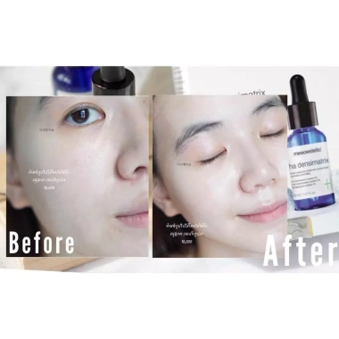 Serum cấp nước Mesoestetic HA Densimatrix 30ml - Dưỡng ẩm, chống lão hóa, da tươi trẻ