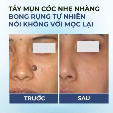 Serum chấm bôi Bellena SC1 trị mụn, cóc, mụn thịt, vết chai, sần giảm giá 137k