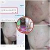 Serum Chấm Mụn 12H Huỳnh Đỗ - Giảm Mụn, Khô Còi, Dưỡng Trắng & Tái Tạo Da, Giá 135k 4