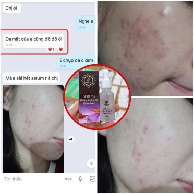 Serum Chấm Mụn 12H Huỳnh Đỗ - Giảm Mụn, Khô Còi, Dưỡng Trắng & Tái Tạo Da, Giá 135k 4