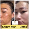 Serum Detox Acnes Bright – Xoá mụn, da sáng, mờ thâm, loại bỏ da sần, vỏ cam – 275.000₫ 6