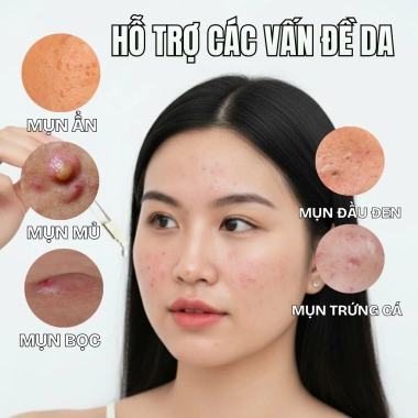 Serum Doctor Care Acne 7ml/20ml – Dưỡng da dầu, ngừa mụn, mờ thâm, thấm nhanh, chỉ 139.000₫ 2