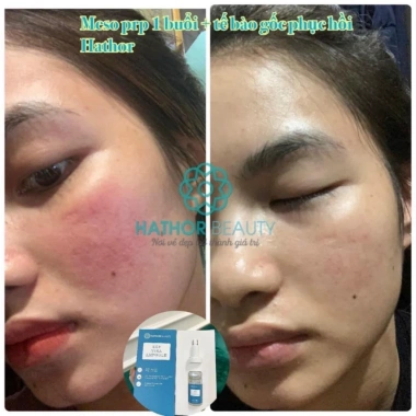 Serum EGF Vira Ampoule 10ml Hathor Beauty: Dưỡng da, phục hồi, giảm giá 450k