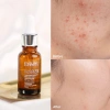 Serum Eveline 10% Niacinamide Glycol Therapy 18ml Giảm mụn, thâm, làm trắng, 200.000 VND 5