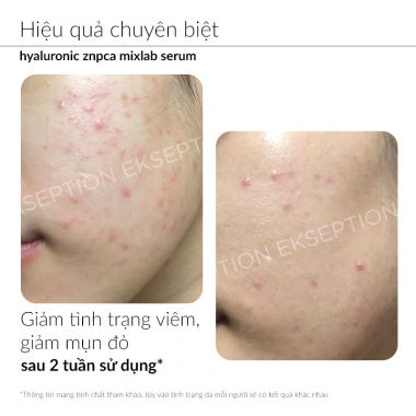 Serum kẽm Ekseption Hyaluronic ZnPCA 1% - Giảm mụn, kiềm dầu 75ml, giá ưu đãi 1.055.460 VNĐ