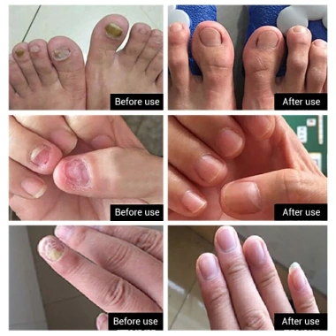Serum Lanbena Phục Hồi Móng Tay Chân Chống Nấm - Nuôi Dưỡng Tái Tạo Móng, Giá 56.000đ