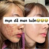 Serum Mụn Hasmi - Phục hồi da, ngăn mụn ẩn & li ti, giảm giá 179.000₫ 8