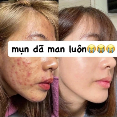 Serum Mụn Hasmi - Phục hồi da, ngăn mụn ẩn & li ti, giảm giá 179.000₫ 8