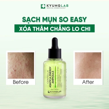 Serum Mụn KyungLab Centella Asiatica 50ml – Giảm mụn, làm dịu, phục hồi da nhạy, 521.100₫