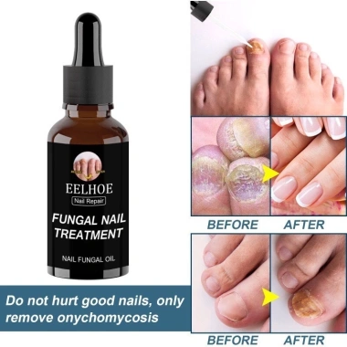 Serum Nấm Móng EELHOE Fungal Nail - Thảo Dược Dưỡng và Phục Hồi Mô Móng Hư, Giảm Giá Đặc Biệt 129k 4 Serum Nấm Móng EELHOE Fungal Nail - Thảo Dược Dưỡng và Phục Hồi Mô Móng Hư, Giảm Giá Đặc Biệt 129k 4