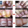 Serum Nấm Móng EELHOE Fungal Nail - Thảo Dược Dưỡng và Phục Hồi Mô Móng Hư, Giảm Giá Đặc Biệt 129k 6