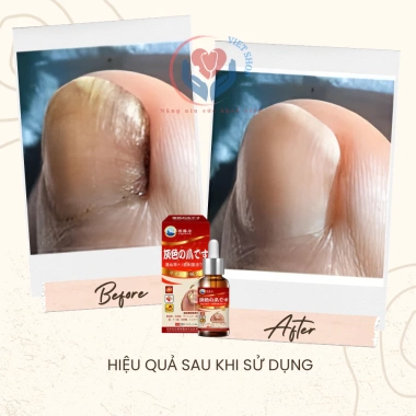 Serum Nấm Móng Nhật Bản Kannedo 30ml - Kháng Khuẩn, Giảm Nấm, Phục Hồi & Dưỡng Móng Khỏe