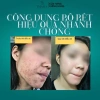 Serum Noãn Thực Vật MH Beauty Spa - Giảm Mụn, Gom Cồi, Kiềm Dầu, Phục Hồi Da - 65k 2