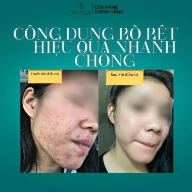 Serum Noãn Thực Vật MH Beauty Spa - Giảm Mụn, Gom Cồi, Kiềm Dầu, Phục Hồi Da - 65k