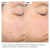 Serum The Ordinary Salicylic Acid 2% giảm mụn ẩn, làm sạch lỗ chân lông 30ml 198k 4