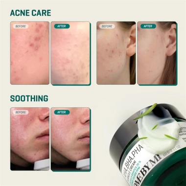 SOME BY MI AHA BHA PHA 30 Days Miracle Dưỡng ẩm 60g, Toner 100ml, Sữa rửa mặt Acne Clear 10ml Giảm giá 204.000 VND 7 SOME BY MI AHA BHA PHA 30 Days Miracle Dưỡng ẩm 60g, Toner 100ml, Sữa rửa mặt Acne Clear 10ml Giảm giá 204.000 VND 7