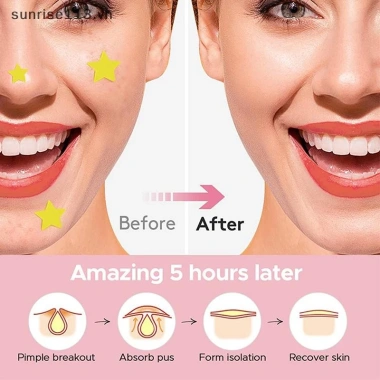 Sr Beauty 240 miếng dán mụn đa màu, che khuyết điểm, chăm sóc da nhanh hiệu quả 5