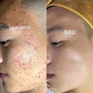 Sữa rửa mặt Karmel không bọt Cleanser và Kem dưỡng ẩm da dầu mụn Freeship quà 4