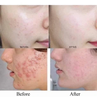 Sữa Rửa Mặt Tạo Bọt Neutrogena Calme Curcuma 150ml - Tinh Chất Nghệ, Dưỡng ẩm, Giảm Mụn, Giá Ưu Đãi 215k 7