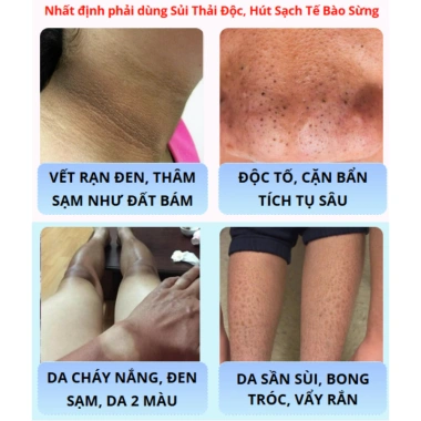 Sủi Thải Độc SHUI MU - Hút Sạch Tế Bào Sừng, Bụi Bẩn, Bọt Tẩy Tế Bào Chết, Dưỡng Da Trắng Sáng, Giá 239.000₫