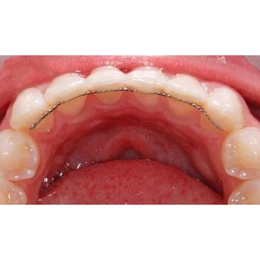 Thanh duy trì cố định sau chỉnh nha - Túi 2 dây hàm trên hàm dưới, thanh dẹt & xoắn 10 dây, 90.000₫ 5