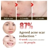 The Ordinary AHA 30% + BHA 2% Peeling 30ml - Tẩy chết, giảm mụn thâm, da sáng 198k 3