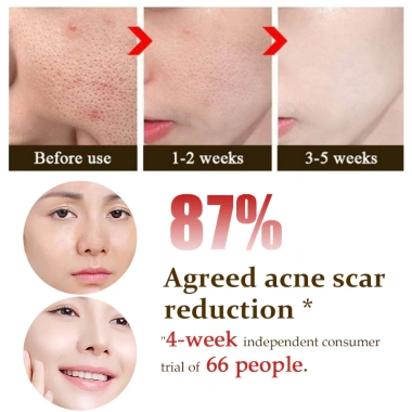The Ordinary AHA 30% + BHA 2% Peeling 30ml - Tẩy chết, giảm mụn thâm, da sáng 198k
