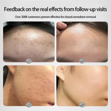 The Ordinary Glycolic Acid 7% Toner tẩy da chết cho da dầu mụn - Chính hãng, giảm giá 257.999₫
