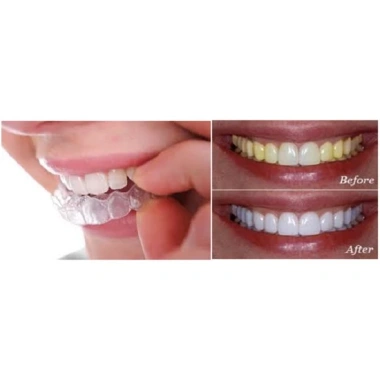 Thuốc Tẩy Trắng Răng Opalescence 10% 15% 20% 35% Chính Hãng Mỹ 90.000 - 75.000