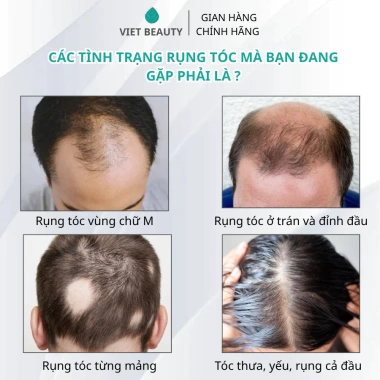 Tinh chất Bio-Placental Scalp Serum VIETBEAUTY - Dưỡng nang tóc, tăng mật độ, giảm rụng tóc - Chỉ 135.000₫