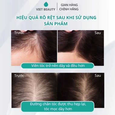 Tinh chất Bio-Placental Scalp Serum VIETBEAUTY - Dưỡng nang tóc, tăng mật độ, giảm rụng tóc - Chỉ 135.000₫