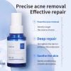 Tinh chất chống mụn lỏng - Loại bỏ mụn trứng cá, giảm đỏ, chống dị ứng, làm dịu da 5