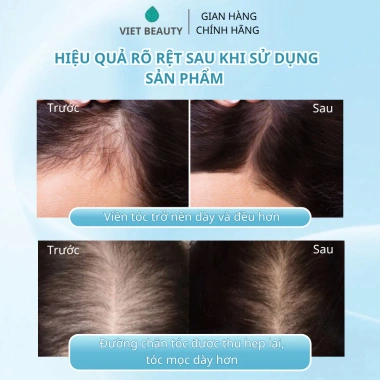 Tinh chất dưỡng nang tóc Bio-Placental Scalp Serum VIETBEAUTY - Tăng mật độ, giảm rụng tóc, giá chỉ 135.000₫ 5 Tinh chất dưỡng nang tóc Bio-Placental Scalp Serum VIETBEAUTY - Tăng mật độ, giảm rụng tóc, giá chỉ 135.000₫ 5