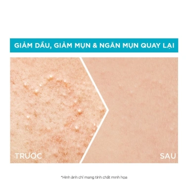 Tinh chất Garnier 4% Niacinamide – Chống mụn, sáng da, Boost Vitamin C, Hyaluron Serum 30ml 4