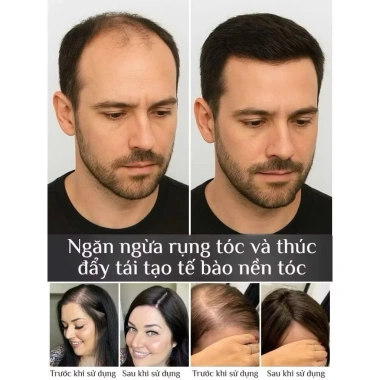 Tinh Chất Móc Tóc Greenvibes Thảo Dược 30ml - Xịt Nuôi Dưỡng, Giảm Rụng Tóc Bạc, Giá 132.000₫ 8