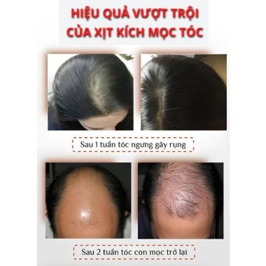 Tinh Chất Mọc Tóc Nhân Sâm SKINZE CQRZEN - Xịt Kích Mọc, Giảm Rụng, Hói Đầu, Dưỡng Nang Tóc Chắc Khỏe 129k 3 Tinh Chất Mọc Tóc Nhân Sâm SKINZE CQRZEN - Xịt Kích Mọc, Giảm Rụng, Hói Đầu, Dưỡng Nang Tóc Chắc Khỏe 129k 3