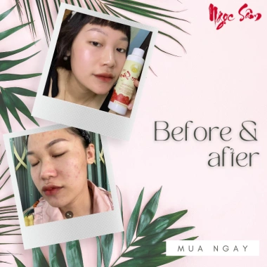 Tinh Chất Ngọc Sâm Ngừa Mụn Thâm, Làm Trắng Da 10ml - Thảo Dược - Giá 70.000 VND