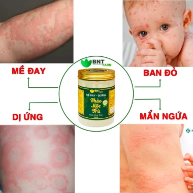 Trà Mề Đay 239k - Giảm Ngứa, Dị Ứng, Ban Đỏ, Mát Gan, Trà Bột Hòa Tan
