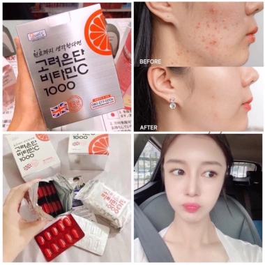 Viên Uống Vitamin C Eundan Trắng Da, Chống Nắng, Giảm Rụng Tóc, Collagen 399k