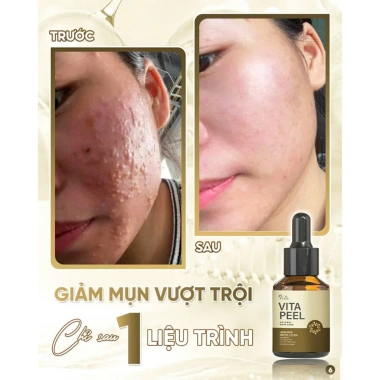 Vita Peel DR.LACIR Tinh Chất Detox Da 50ml Trẻ Hóa Da Sáng Mịn Giá Ưu Đãi 385.000₫