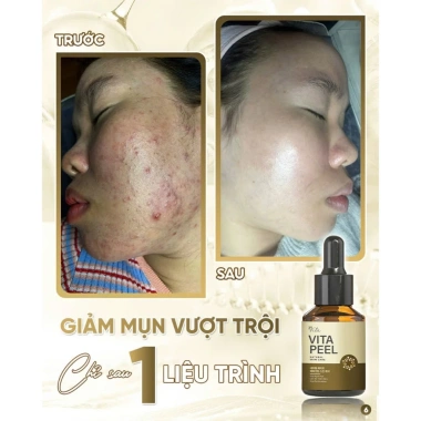 Vita Peel DR.LACIR Tinh Chất Detox Da 50ml Trẻ Hóa Da Sáng Mịn Giá Ưu Đãi 385.000₫